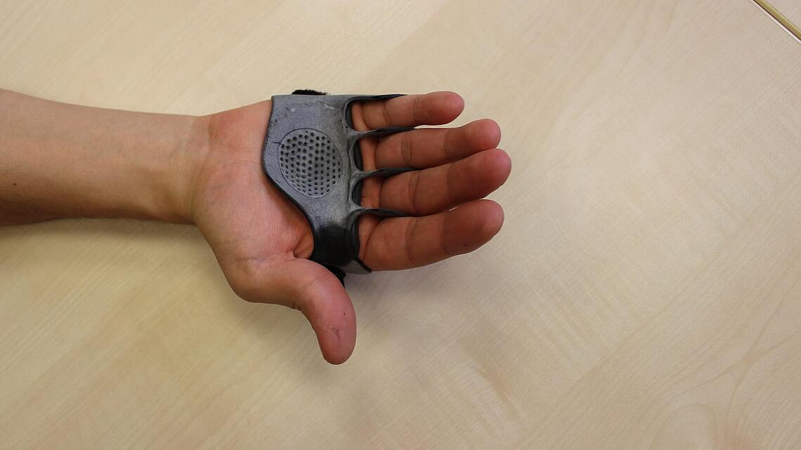 Fingerkorrektur dank einer Ulnardeviationsorthese aus dem 3D-Drucker Finger werden durch eine Ulnardeviationsorthese aus dem 3D-Drucker geführt und die Fehlstellung korrigiert