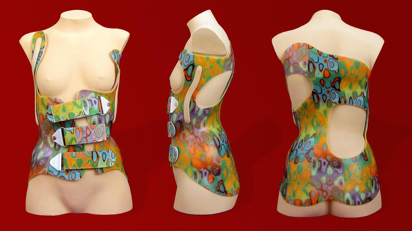 verschiedene Ansichten einer bunten Rumpforthese bei einer Skoliose