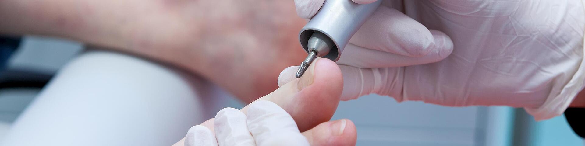 Fußnagelfeilen in der Podologie Feilen eines Zehennagels mit elektrischer Feile in der Podologie