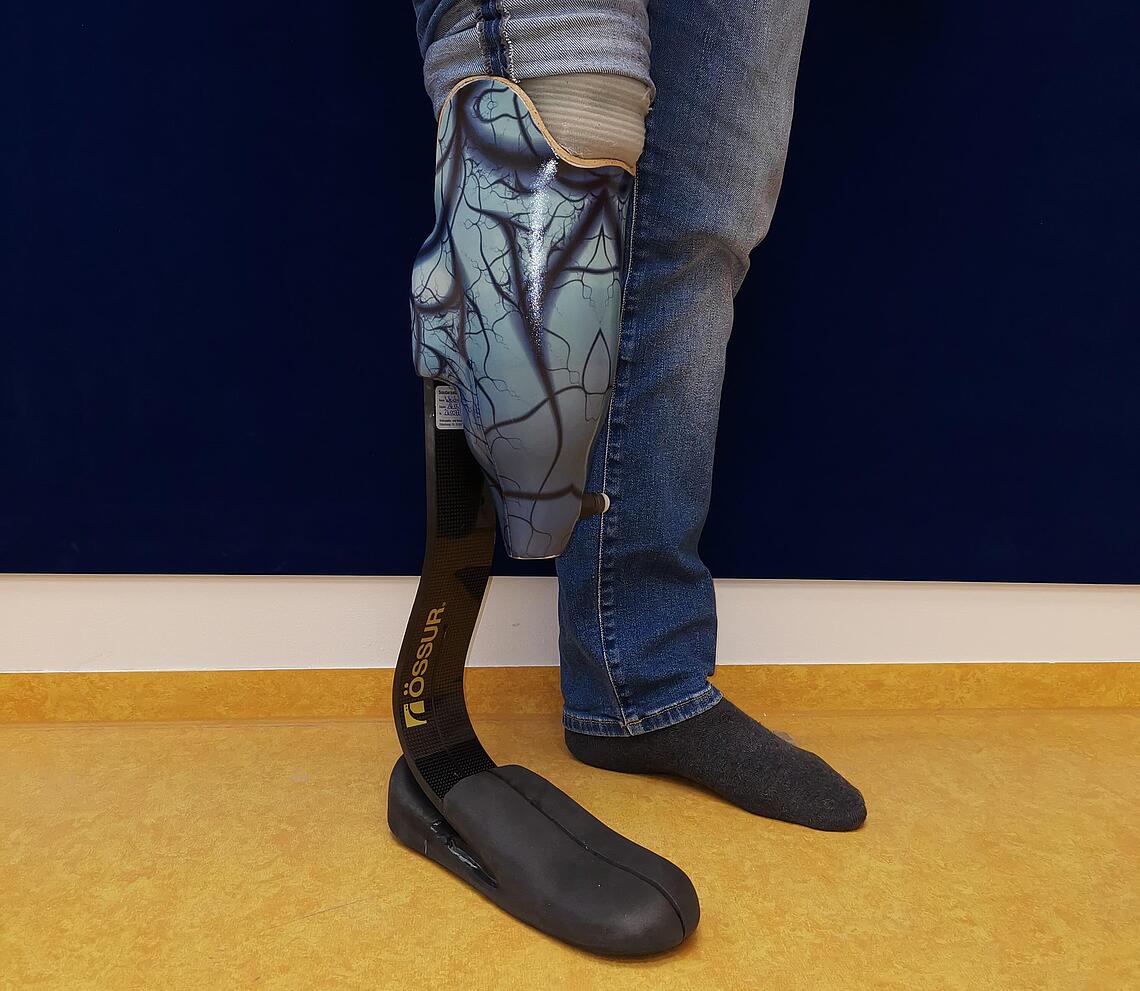 Unterschenkelprothese mit gedrucktem blauen Cover