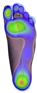 Scan-Bild einer belasteten Fußsohle mit entsprechenden Druckpunkten bei normaler gleichmäßiger Belastung